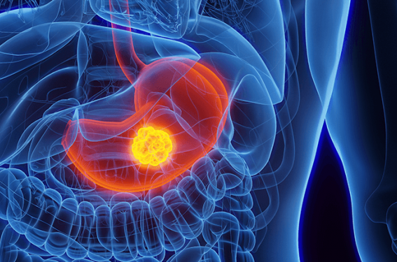 cancer gastrique