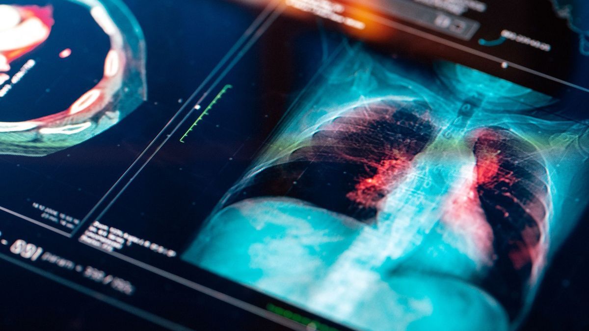 Cancer du poumon : Le traitement à la carte a doublé le taux de survie