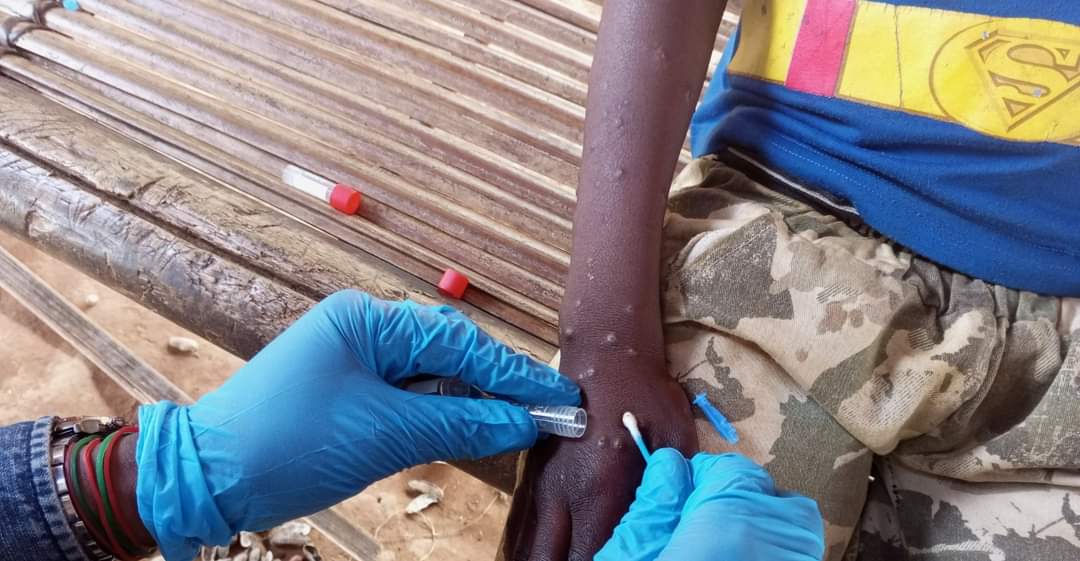Variole du Singe: L'Algérie actionne le dispositif de surveillance et d'alerte