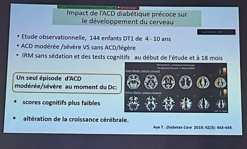 L’acidocétose diabétique chez l’enfant : l’urgence d’un plan de prévention