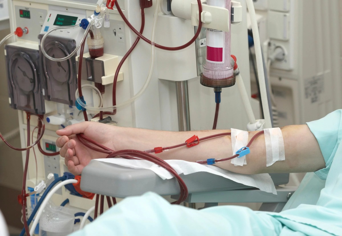 Appel a l’introduction de la dialyse à haute perméabilité dans les centres privés