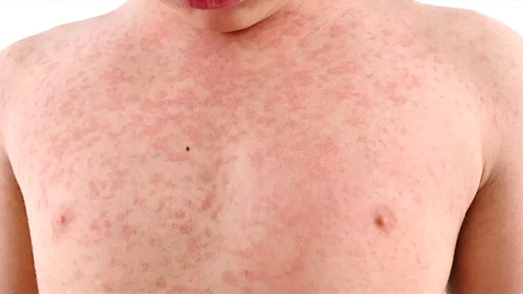 États-Unis : Une épidémie de rougeole relance le débat sur la vaccination