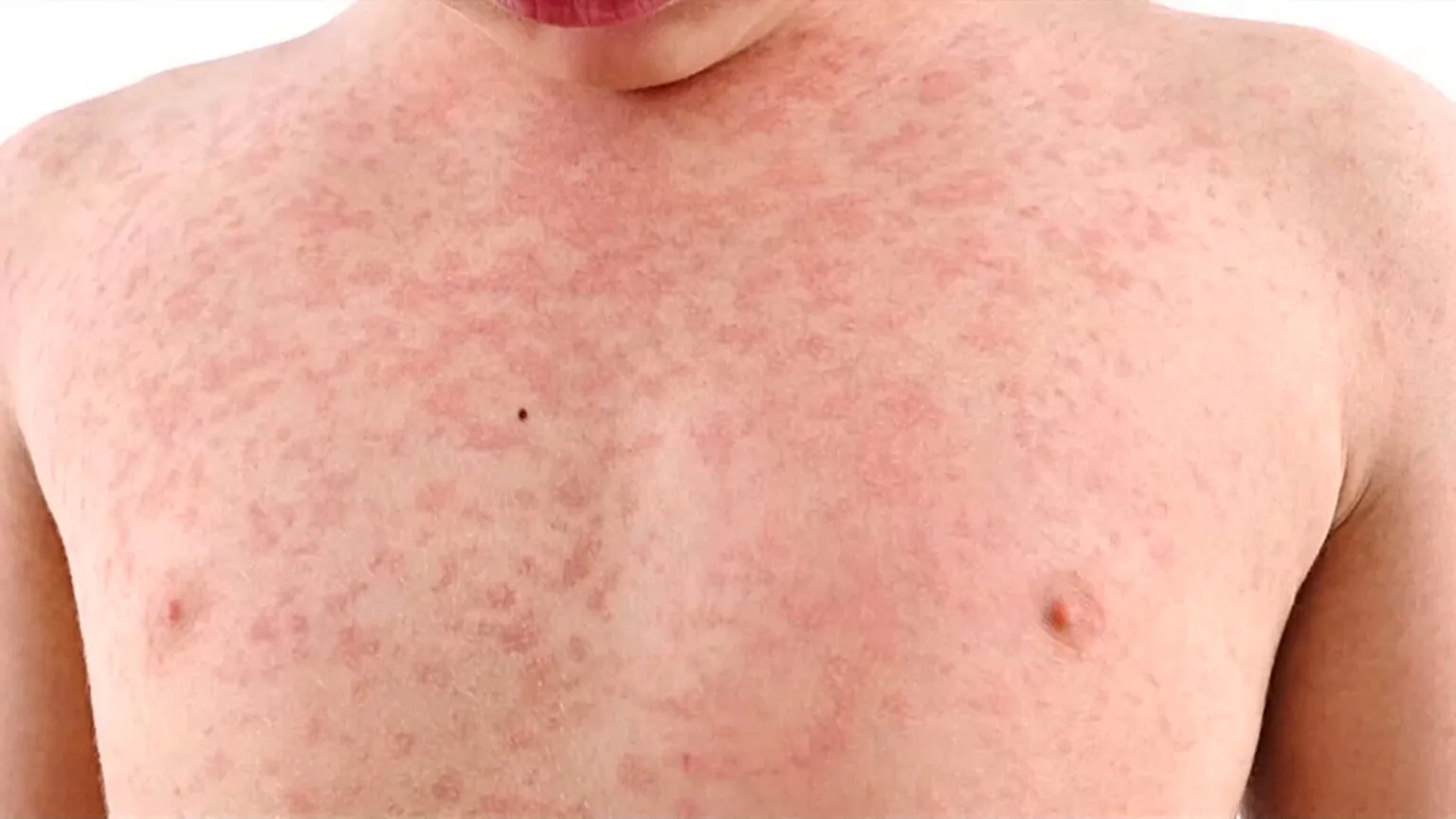 États-Unis : Une épidémie de rougeole relance le débat sur la vaccination