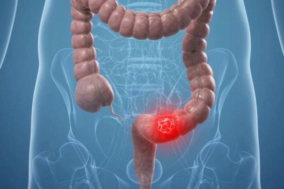 cancer-colorectal-augmentation-mondiale-jeunes-moins-50-ans-microbiote