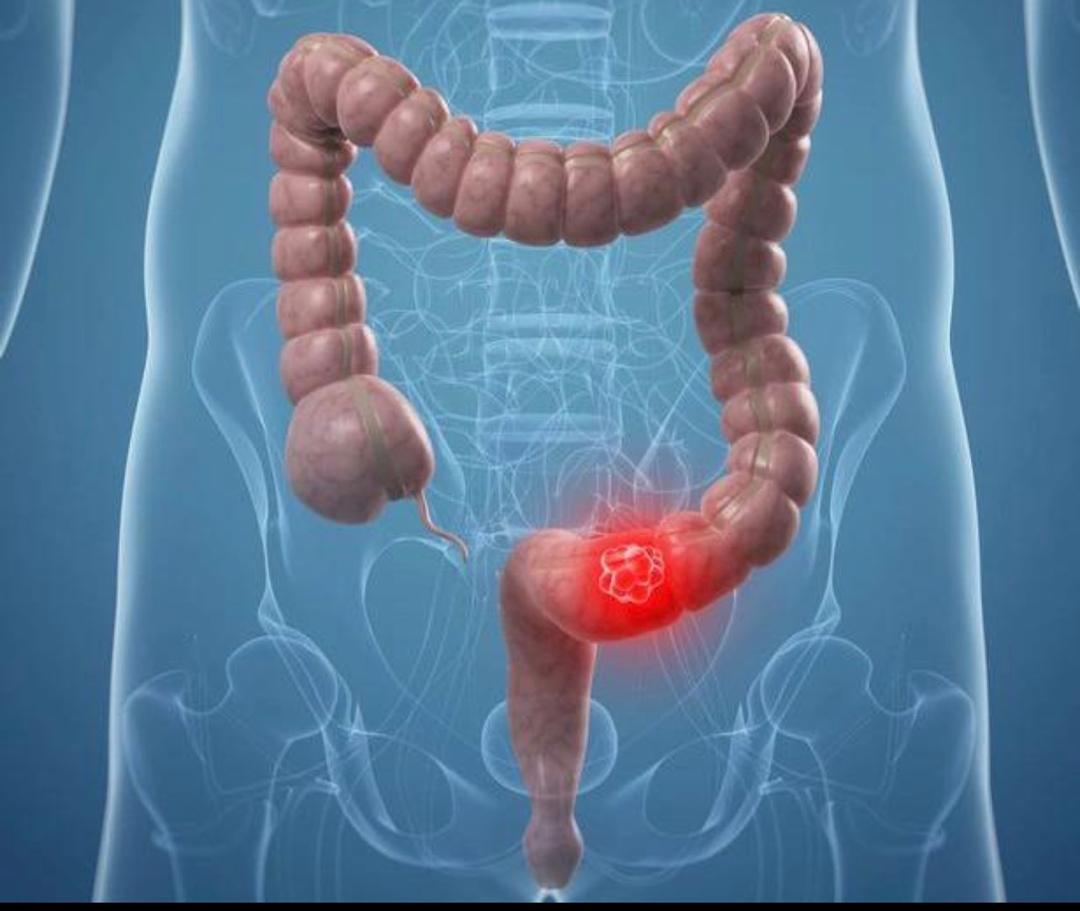 Cancer colorectal : l’augmentation mondiale des cas inquiète, notamment chez les moins de 50 ans