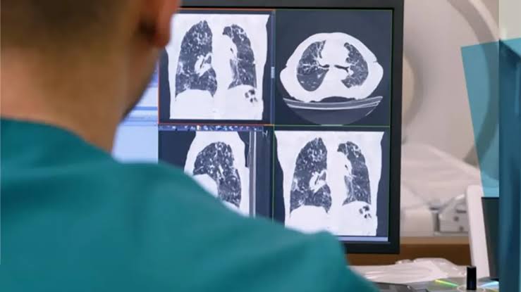 Dépistage du cancer du poumon : Olea Medical et Median Technologies s’allient pour le déploiement d’une solution IA